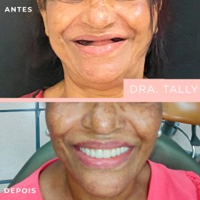 img implantes dentarios dra tally (2)