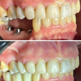img implantes dentarios dra tally (3)