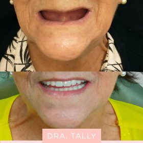img implantes dentarios dra tally (5)